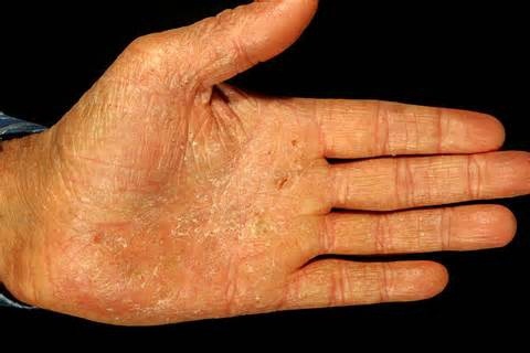 How To Treat Eczema On Hands And Feet Enkivillage